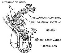 Hernia en escroto